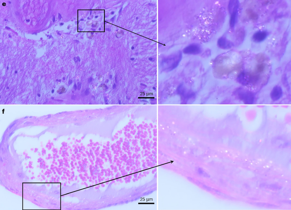 Estudo encontra níveis alarmantes de microplástico em cérebro humano